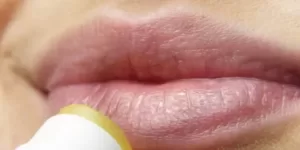 Herpes Labial