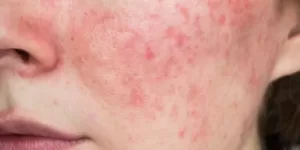 Rosacea