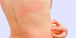 urticaria pigmentosa