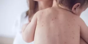 Varicela