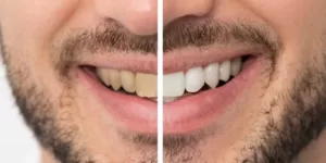 Blanquear los dientes
