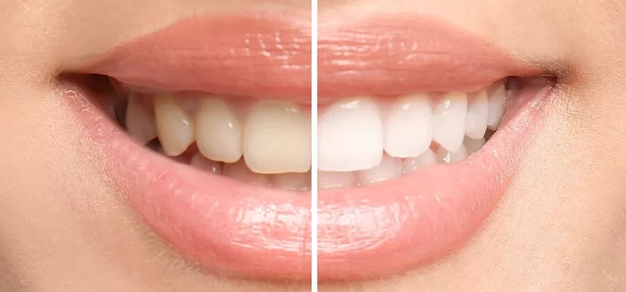 blanquear los dientes es fácil con WhiteNat